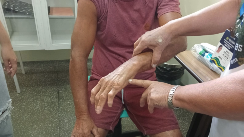 Em seis meses, Dermato Saúde realizou mais de 13 mil exames dermatológicos no interior do Amazonas 2 Em seis meses Dermato Saude realizou mais de 13 mil exames dermatologicos no interior do Amazonas 7 Foto Arnoldo Santos Fuham